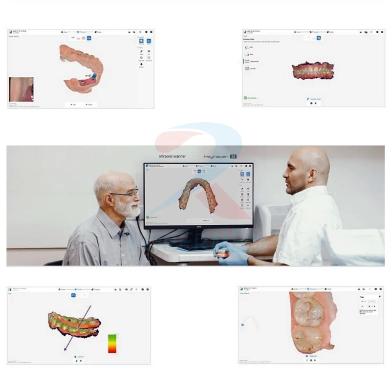 intra oral scanners for digital impression (4) intra oral scanners for digital impression (4)
